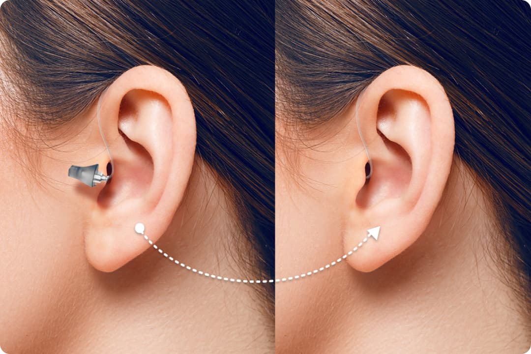Split-screen van oor van vrouw met bruin haar, heeft achter-het-oor minihoortoestel in